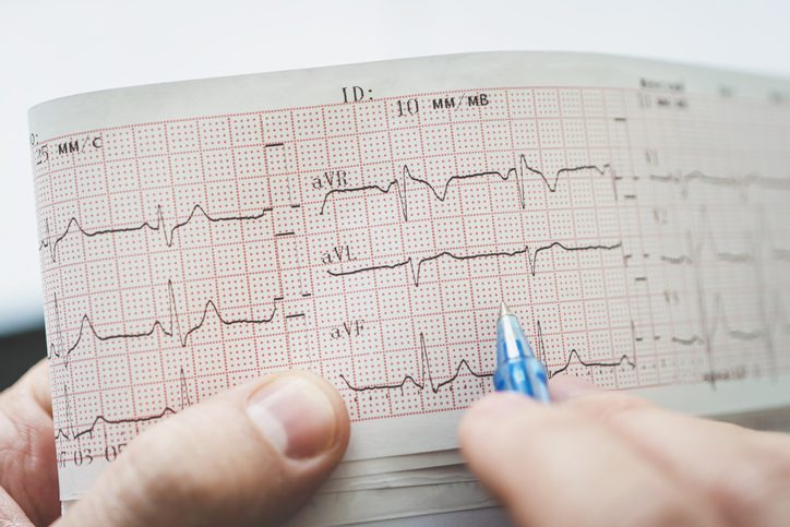 QTc Prolongation in Psychiatric Hospitalization