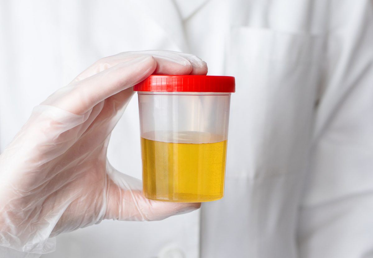 An Adulterated Urine Buprenorphine Specimen