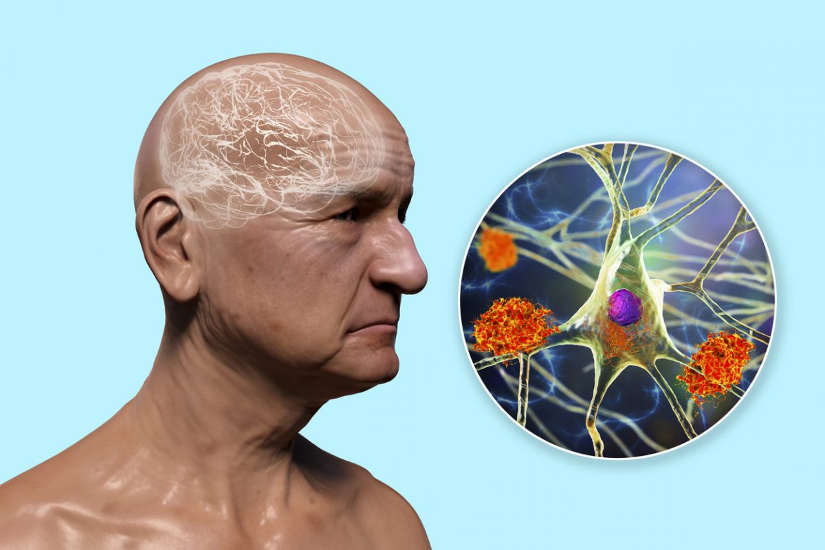 Cerebral Amyloid Angiopathy