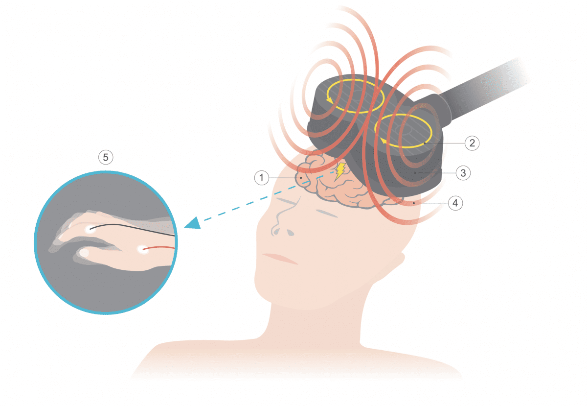 TMS in Anxious Depression