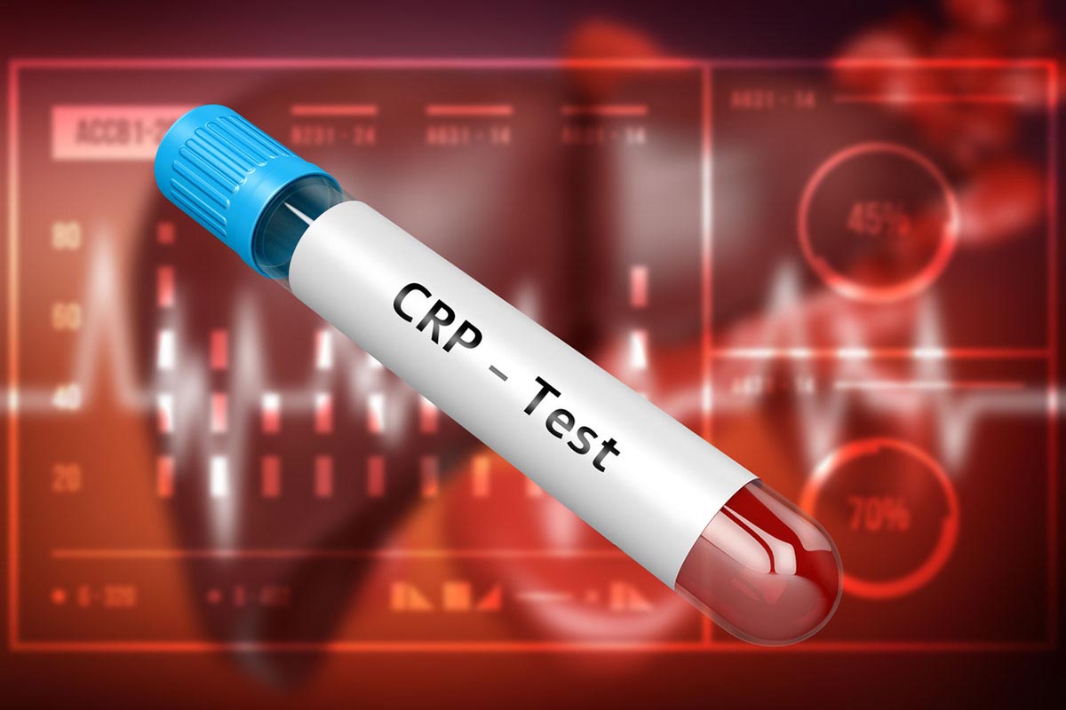 C-Reactive Protein, Attention, and Gray Matter in Offspring of Patients With Bipolar Disorder