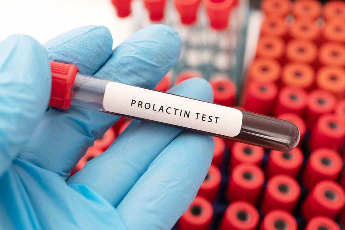 High Levels of Prolactin With Amisulpride