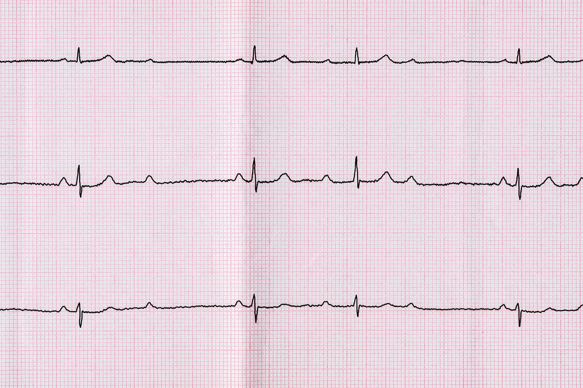 Third-Degree AV Block With High-Dose Lamotrigine 