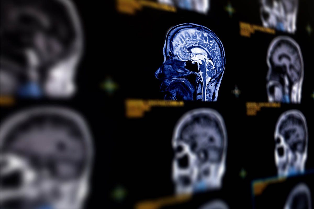 Catatonia in the Context of Cerebral Venous Sinus Thrombosis