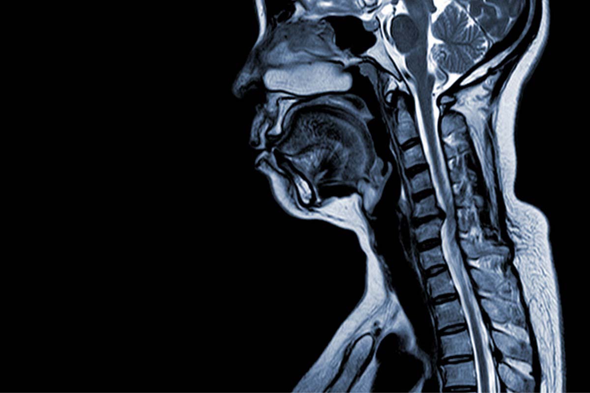 Perceived Stress Associated With COVID-19 in Neuro-Behcet’s Disease