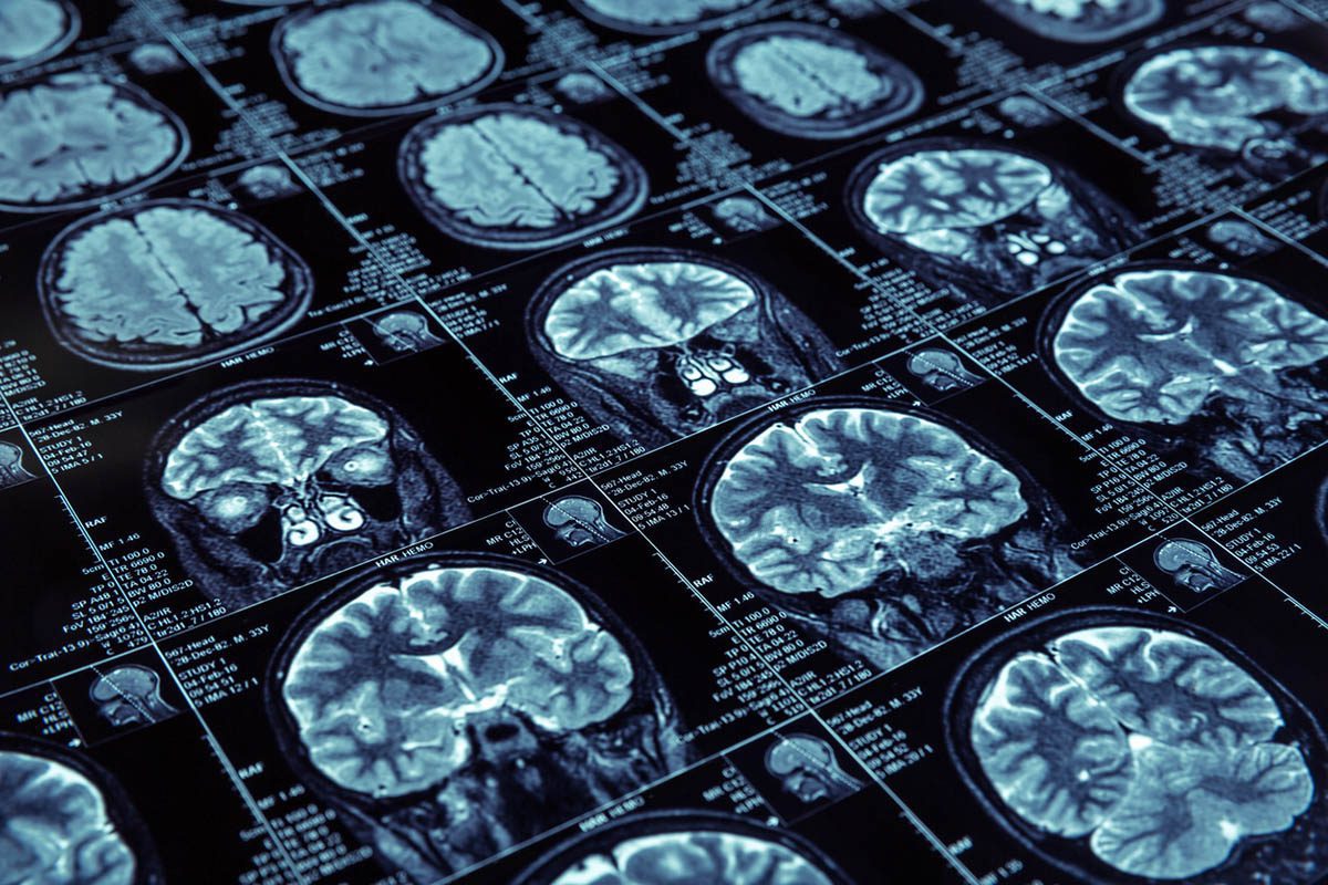 A Fully Remote Randomized Trial of Transcranial Alternating Current Stimulation for the Acute Treatment of Major Depressive Disorder