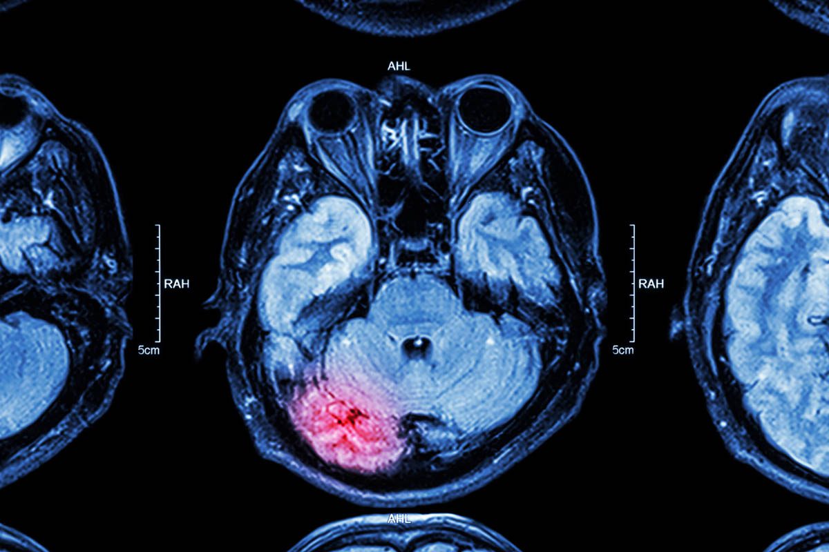 Pharmacologic Management of the Sequelae of Traumatic Brain Injuries